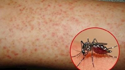 Sốt xuất huyết: Bệnh quen nhưng đừng chủ quan