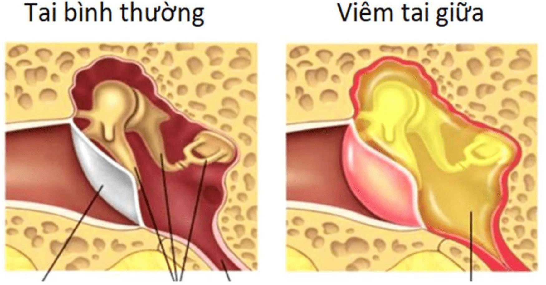 VIÊM TAI GIỮA CẤP – XIN ĐỪNG CHỦ QUAN