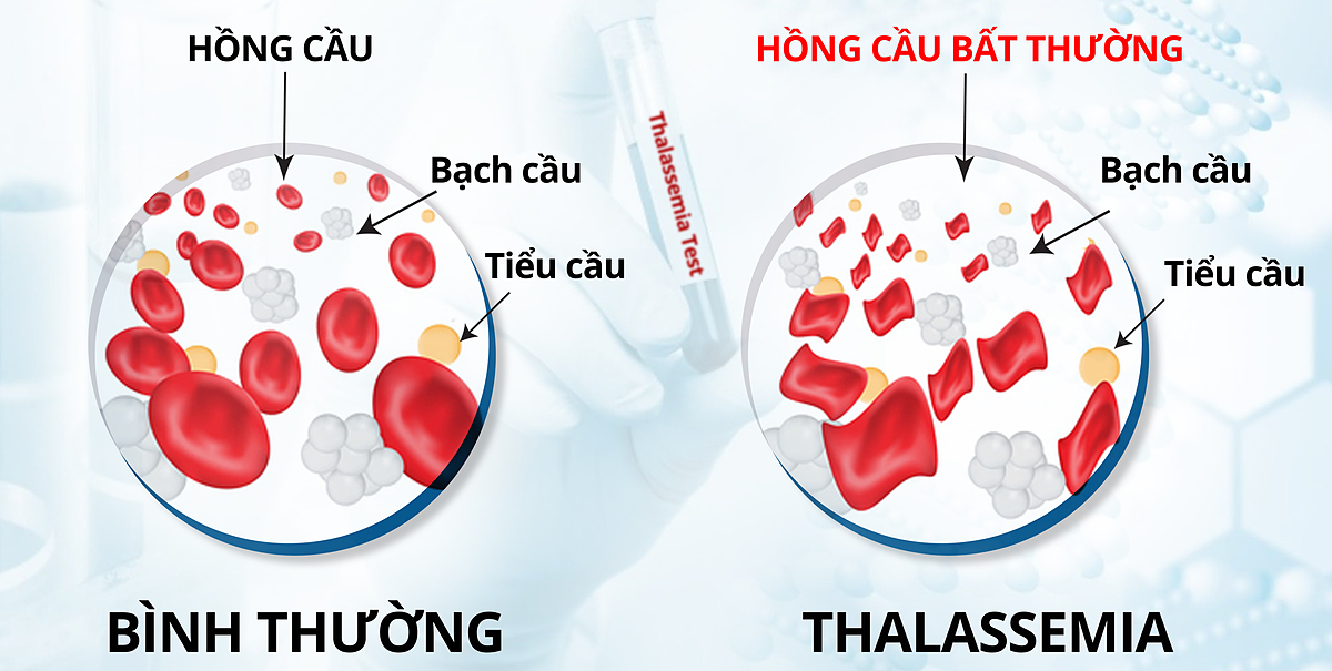 TAN MÁU BẨM SINH (THALASSEMIA): ĐỪNG ĐỂ CON TRẺ MANG GÁNH NẶNG SUỐT ĐỜI