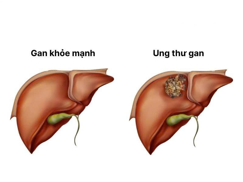 HIỂU ĐÚNG VỀ UNG THƯ
Để bảo vệ chính mình
Kỳ 5:
UNG THƯ GAN:  Âm thầm, nguy hiểm, nhưng có thể phát hiện sớm