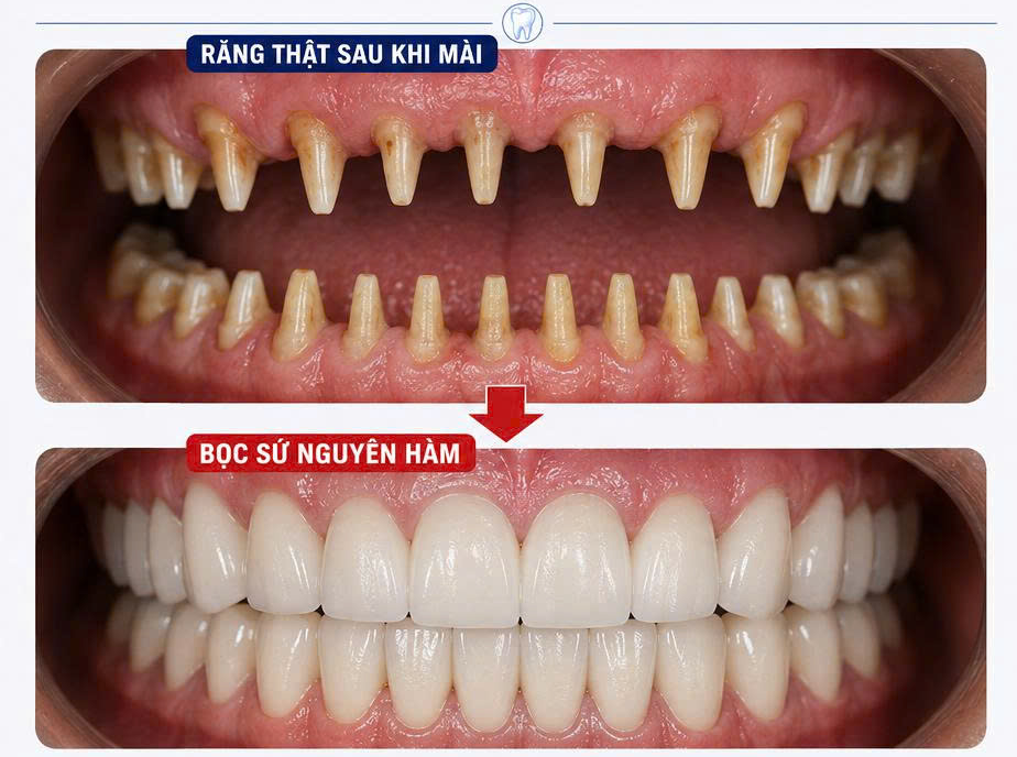 Mài răng thật, bọc răng sứ thẩm mỹ: nên chăng?