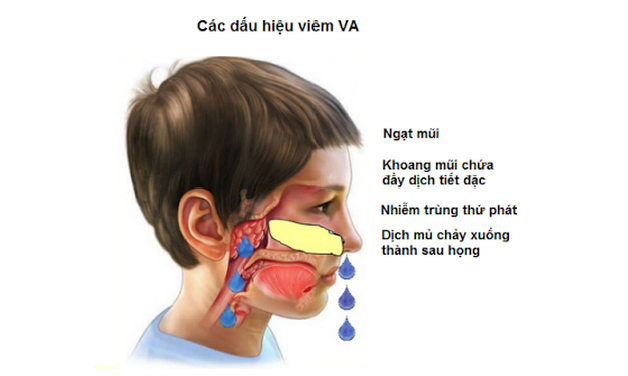 Khi nào trẻ cần nạo VA?
