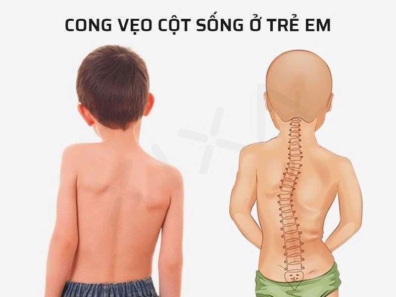 Cong vẹo cột sống ở trẻ em: ĐỪNG ĐỂ TRẺ MANG TẬT SUỐT ĐỜI