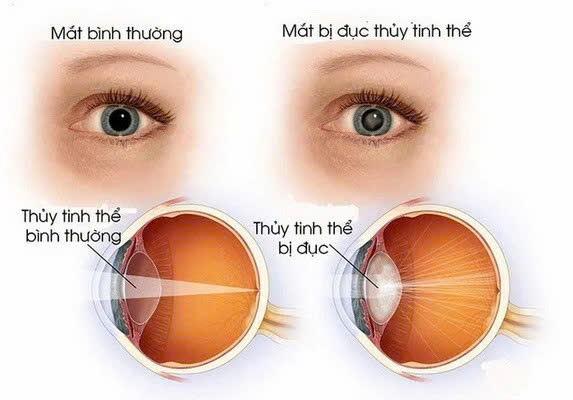 Đục thủy tinh thể – Nguyên nhân hàng đầu gây mù lòa ở người cao tuổi