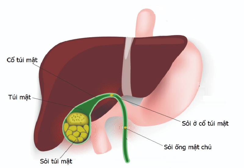 ĂN UỐNG THẾ NÀO SAU KHI CẮT BỎ TÚI MẬT?