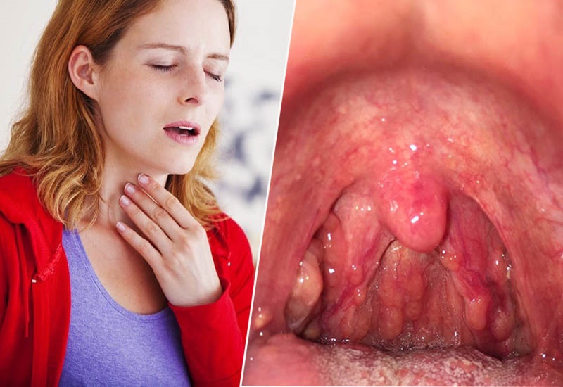 Tăng sinh mô lympho thành sau họng (viêm họng hạt): 
Phải làm sao?