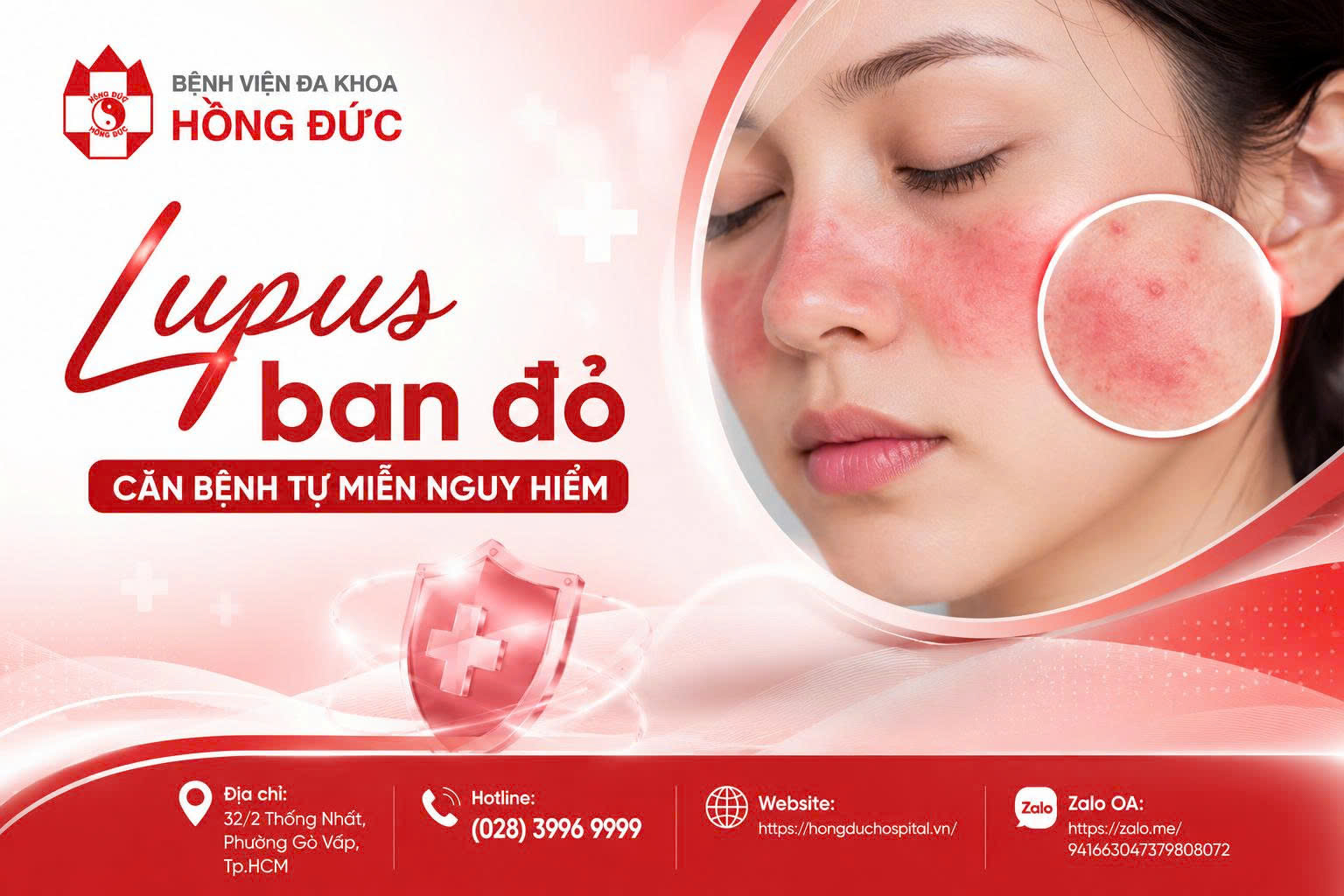 Lupus ban đỏ: Căn bệnh tự miễn nguy hiểm