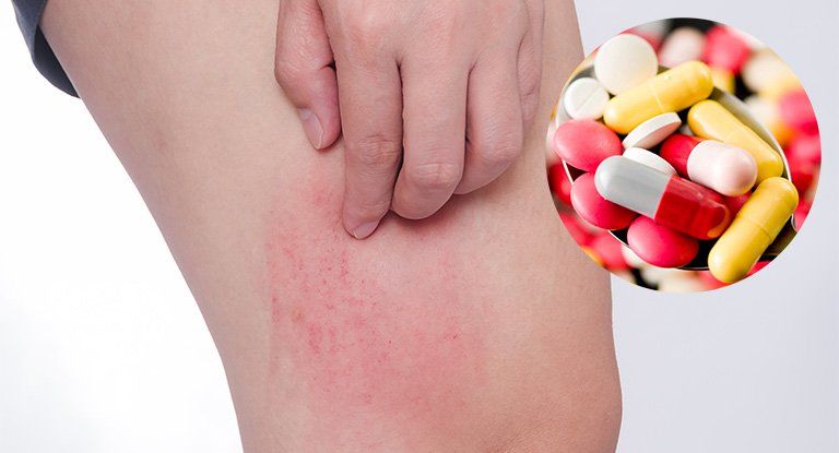 Sốc phản vệ: Người đàn ông nhập viện cấp cứu