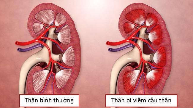 VIÊM CẦU THẬN: KHI “BỘ LỌC” CỦA THẬN BỊ TỔN THƯƠNG