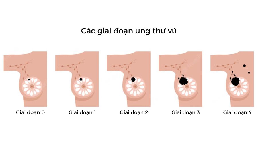 HIỂU ĐÚNG VỀ UNG THƯ
Để bảo vệ chính mình
Kỳ 7: UNG THƯ GIAI ĐOẠN 0 LÀ GÌ?