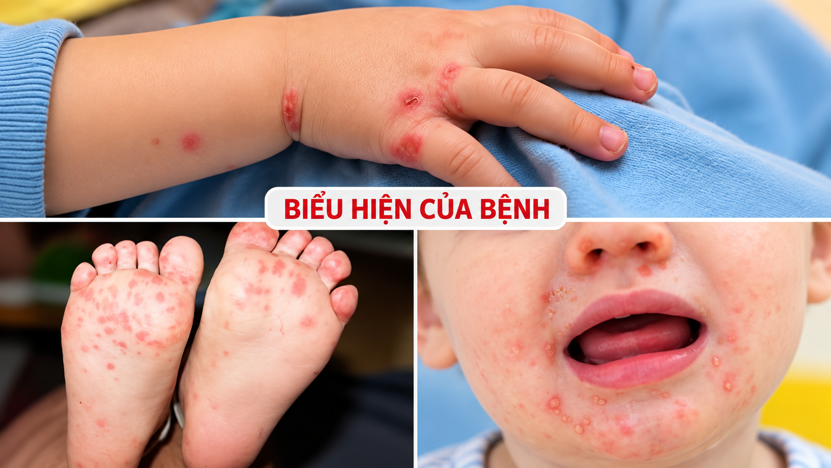 Cảnh báo sốt xuất huyết, tay chân miệng mùa mưa: Chủ động phòng bệnh từ gia đình đến trường học