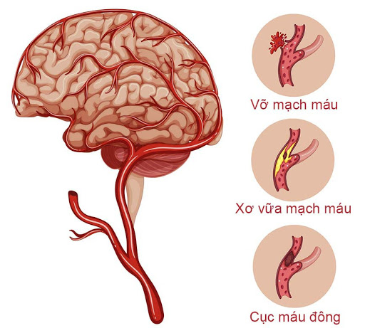 NHỮNG DẤU HIỆU SỚM CỦA XUẤT HUYẾT NÃO