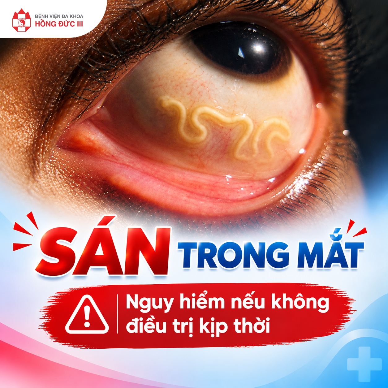 SÁN TRONG MẮT: Nguy hiểm nếu không điều trị kịp thời