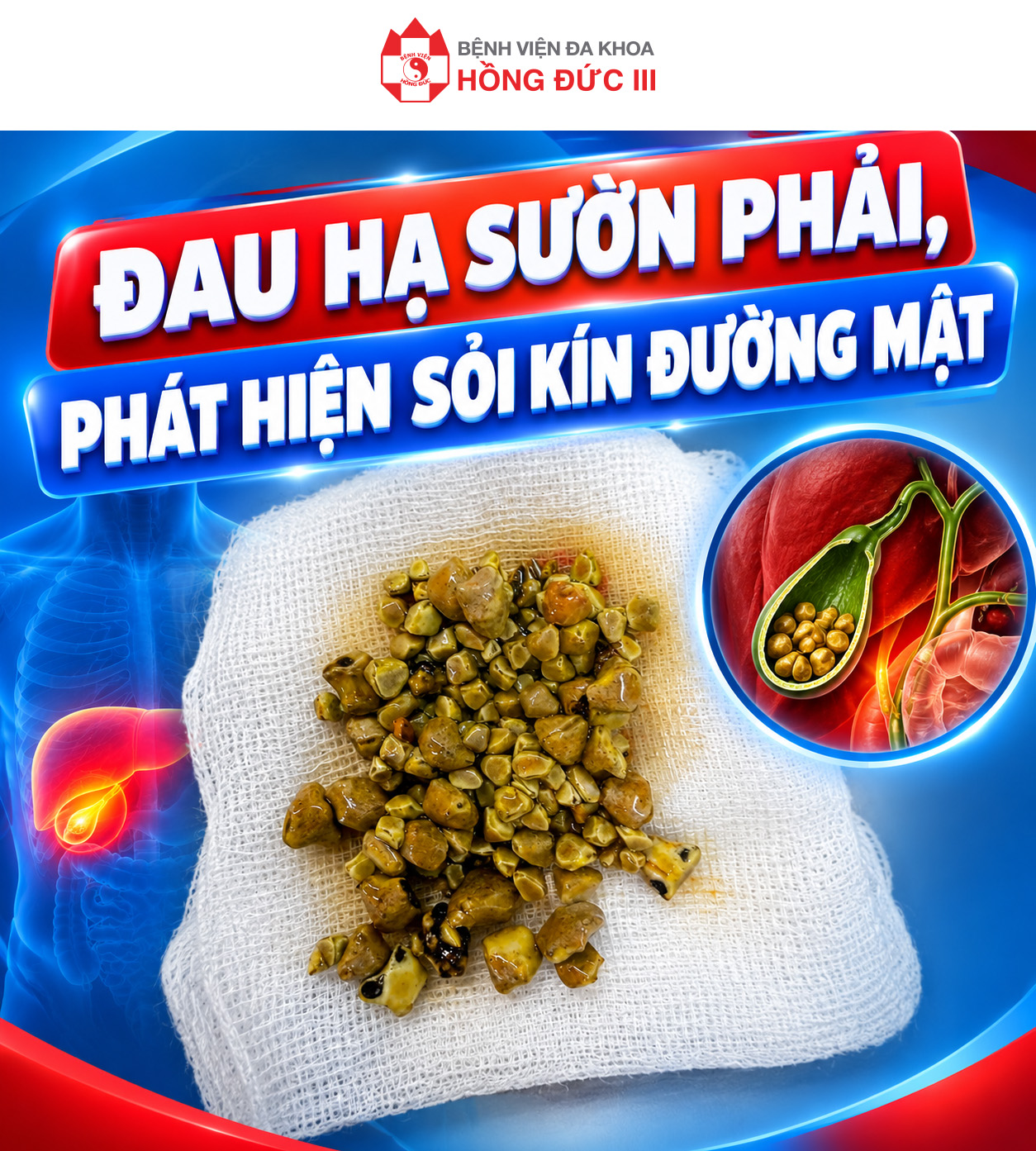 ĐAU HẠ SƯỜN PHẢI, PHÁT HIỆN SỎI KÍN ĐƯỜNG MẬT