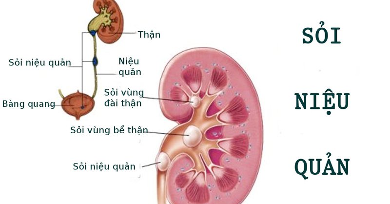 SỎI HÌNH THÀNH TRONG CƠ THỂ NHƯ THẾ NÀO?