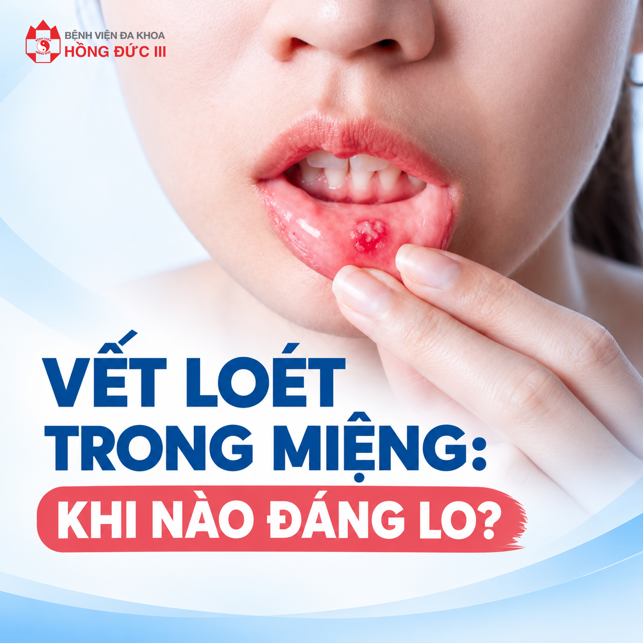 VẾT LOÉT TRONG MIỆNG: KHI NÀO ĐÁNG LO?