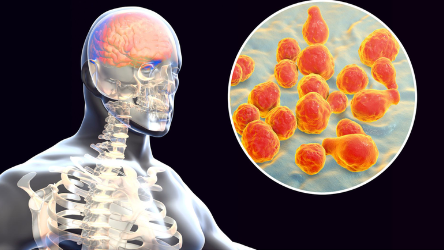 Não mô cầu nhóm B: Ai cần tiêm vaccine?