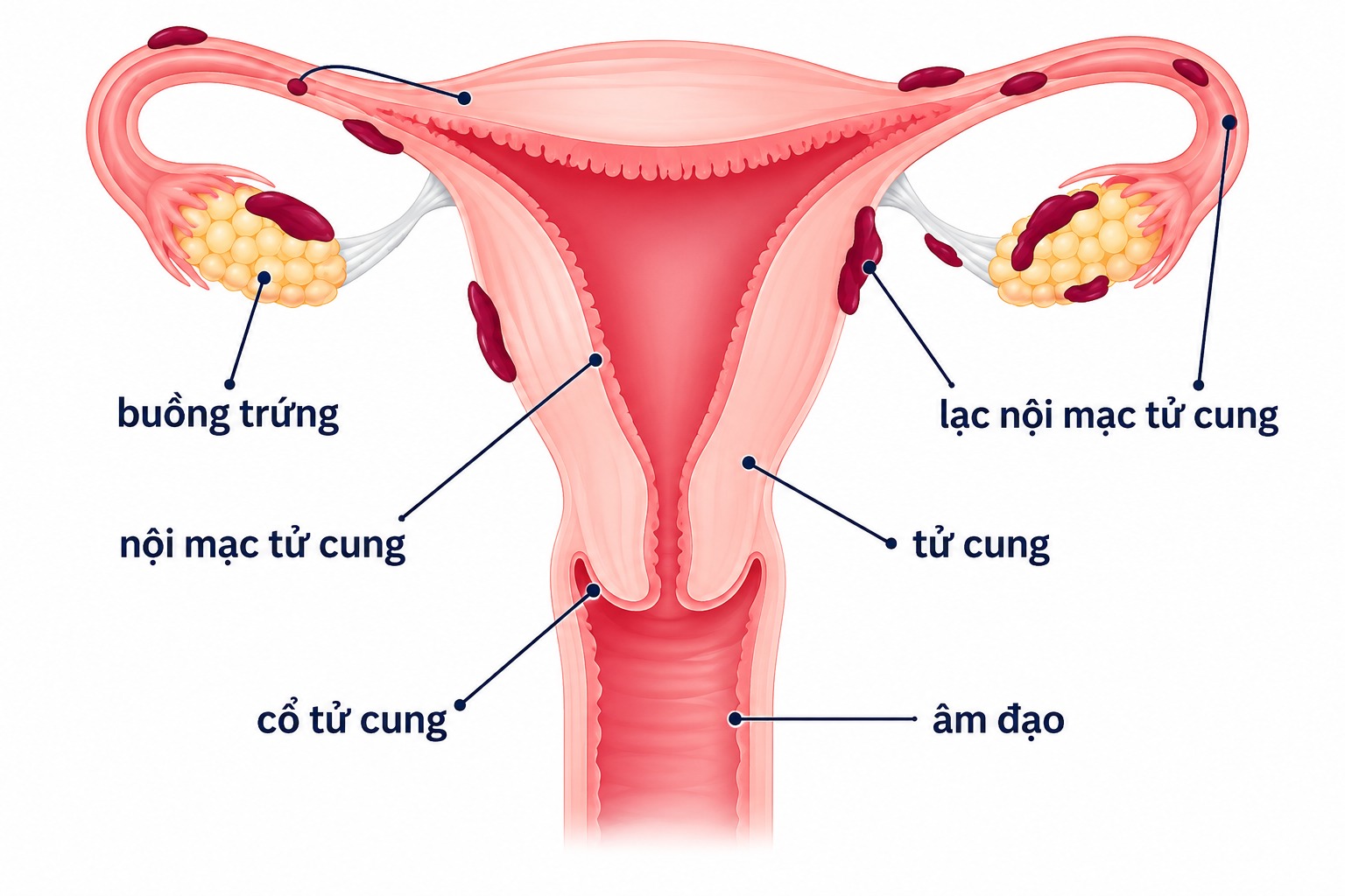 Lạc nội mạc tử cung: ĐỪNG CHỦ QUAN KHI ĐAU BỤNG KINH KÉO DÀI