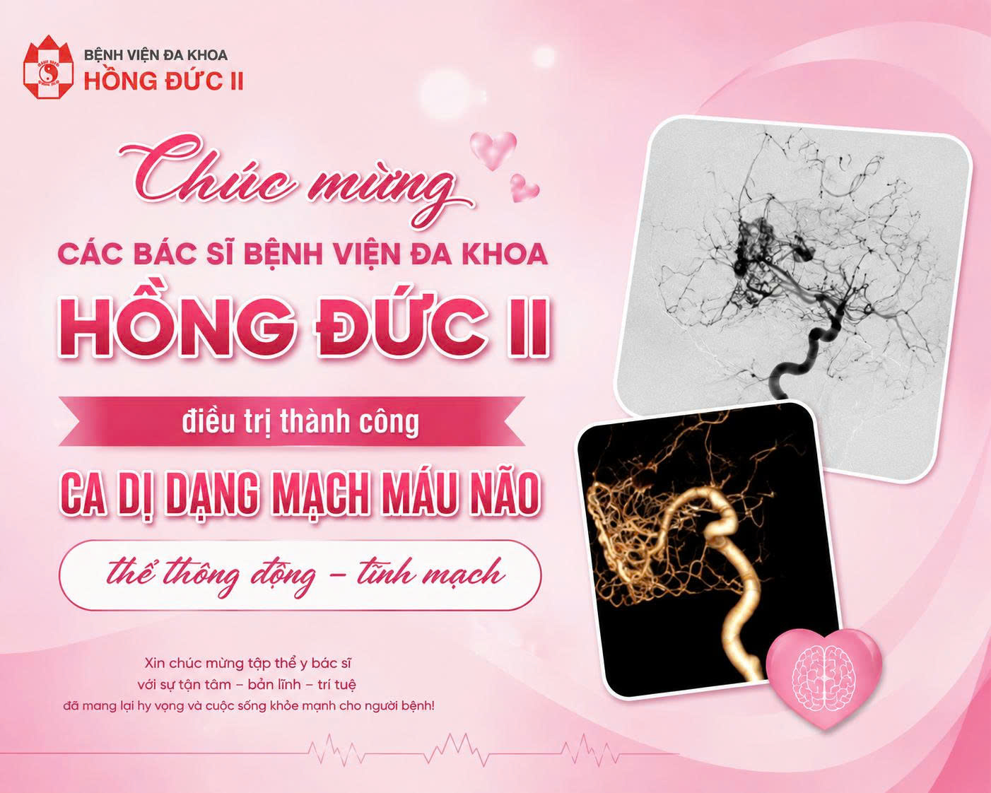 Một trường hợp dị dạng mạch máu não phức tạp được điều trị tại Bệnh viện Đa khoa Hồng Đức II